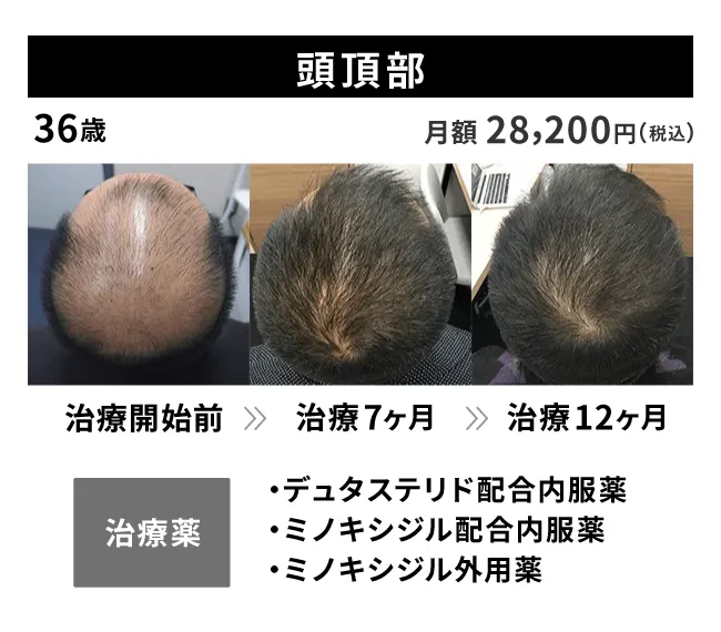 36歳・頭頂部の治療事例 治療開始前から12ヶ月後