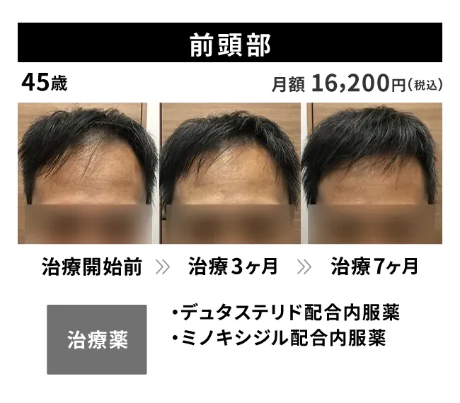 45歳・前頭部の治療事例 治療開始前から7ヶ月後