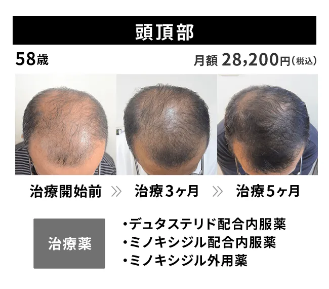 58歳・頭頂部の治療事例 治療開始前から5ヶ月後