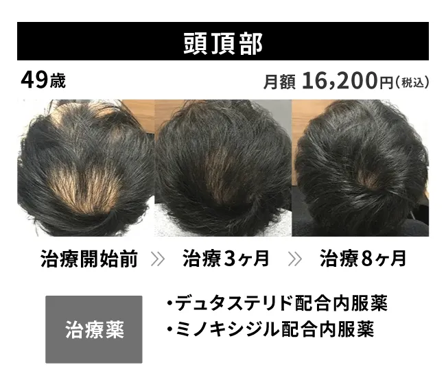 49歳・頭頂部の治療事例 治療開始前から8ヶ月後