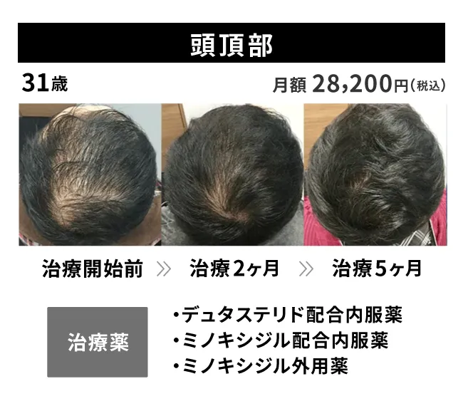 31歳・頭頂部の治療事例 治療開始前から5ヶ月後