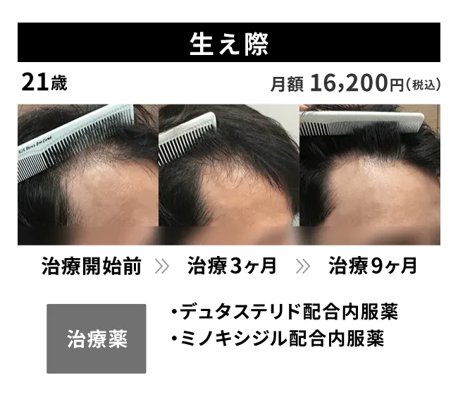 21歳・生え際の治療事例 治療開始前から9ヶ月後