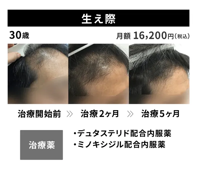 30歳・生え際の治療事例 治療開始前から5ヶ月後