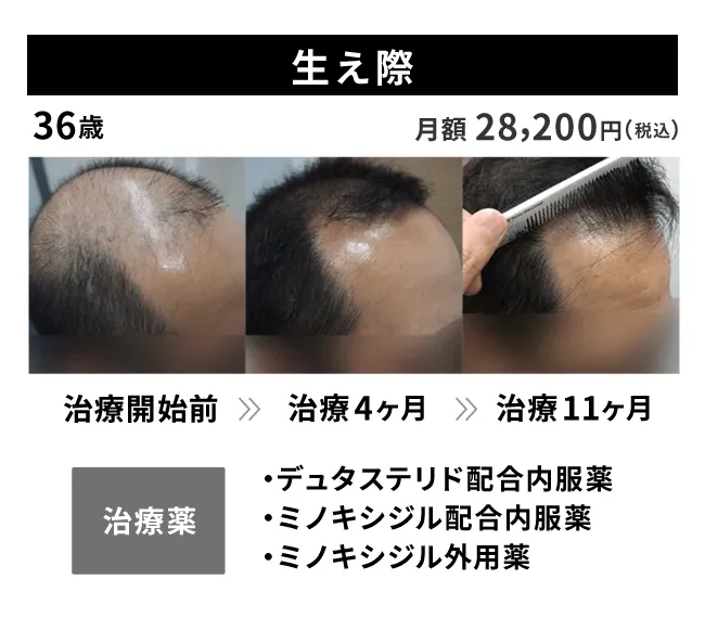 36歳・生え際の治療事例 治療開始前から11ヶ月後