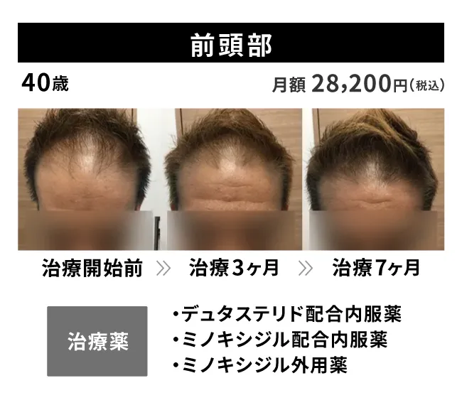 40歳・前頭部の治療事例 治療開始前から7ヶ月後