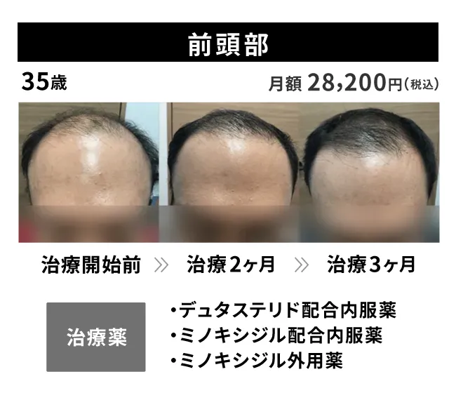 35歳・前頭部の治療事例 治療開始前から3ヶ月後